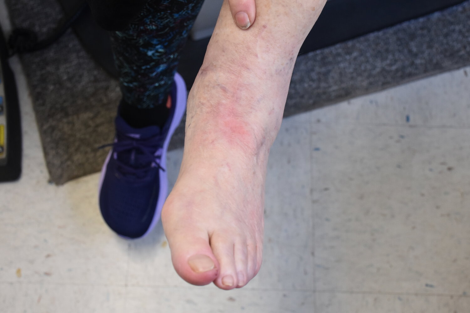 Ankle-replacement patient Maureen McHale points to the tiny, barely visible scar left from her procedure.